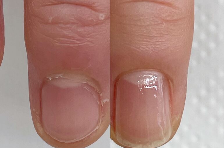 ネイルケアBefore After