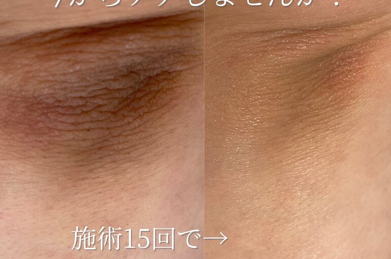 ひじトリートメント