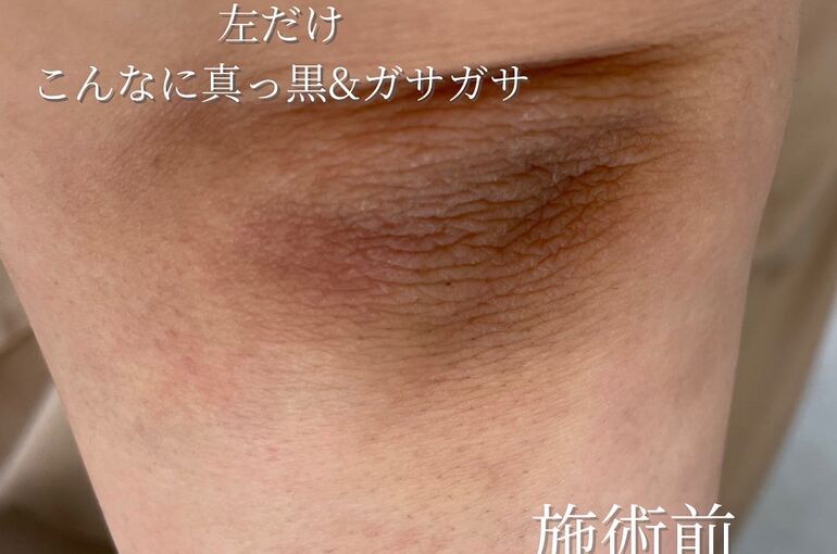 ひじの写真