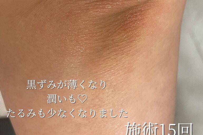 ひじの写真