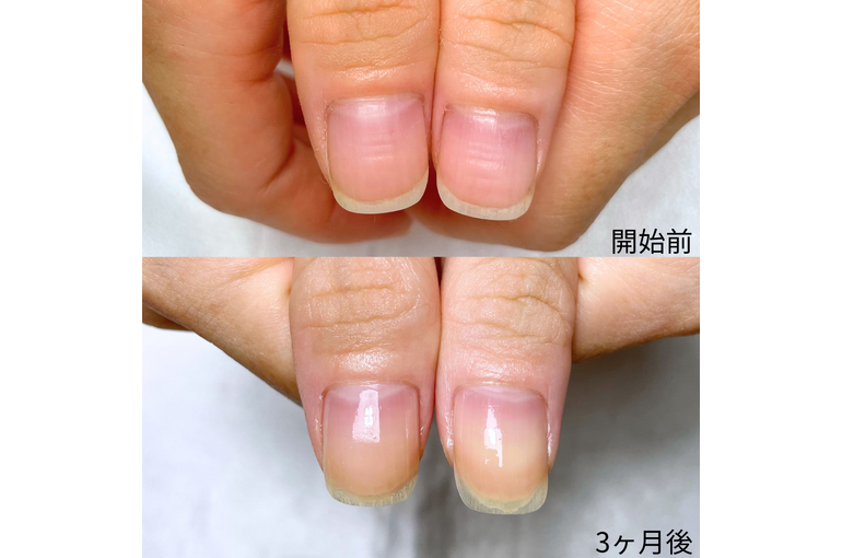 自爪育成