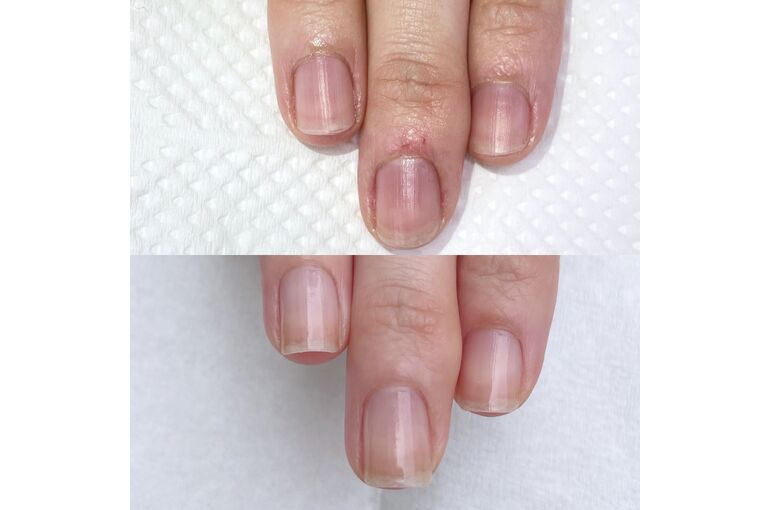 自爪育成beforeAfter