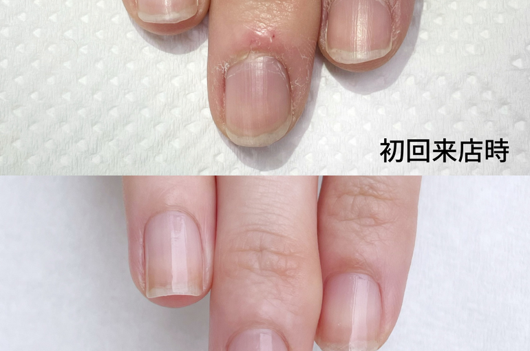 自爪育成