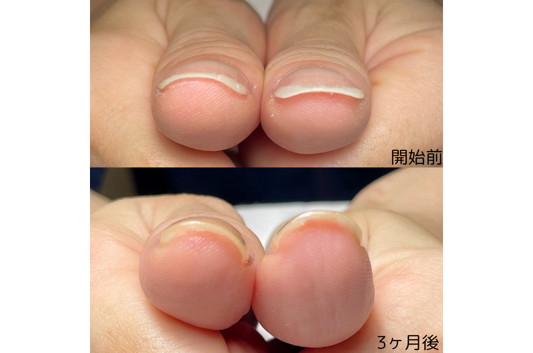 自爪育成