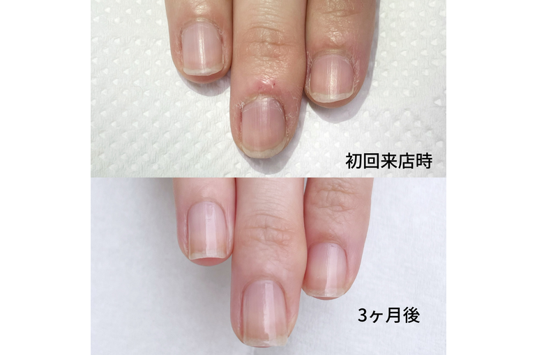 自爪育成
