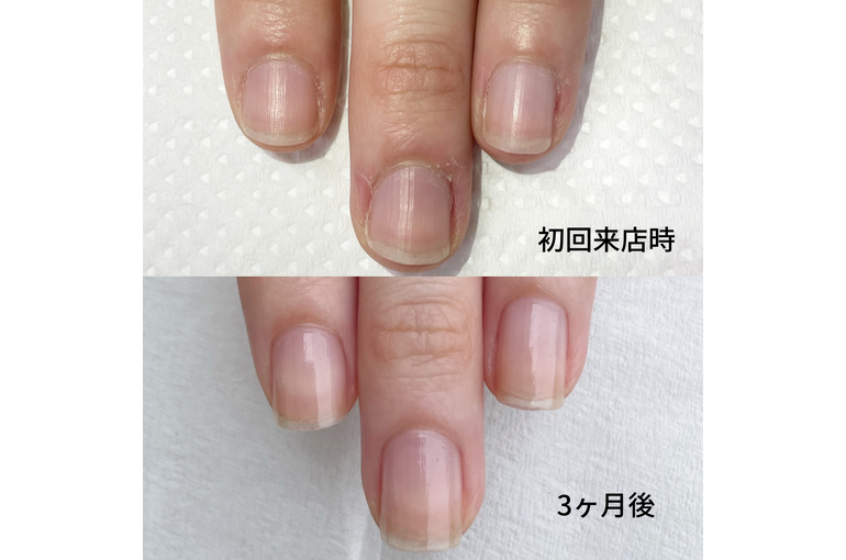 自爪育成