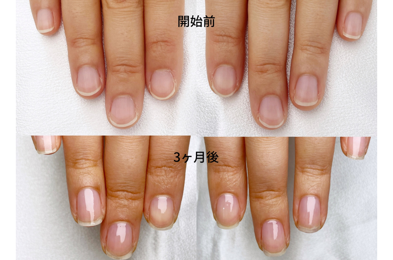Resh nail自爪育成3ヶ月で変化したビフォーアフター写真｜市川ネイルサロン