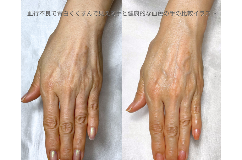 血行不良で青白くくすんで見える手と健康的な血色の手の比較イラスト
