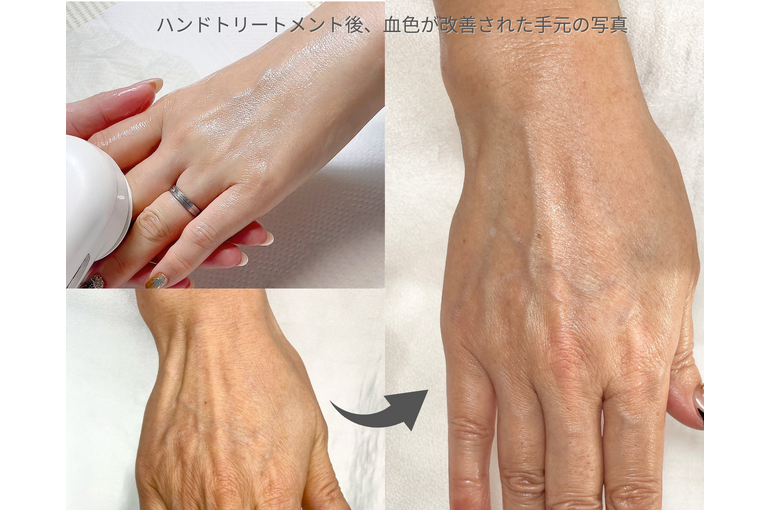 ハンドトリートメント後、血色が改善された手元の写真