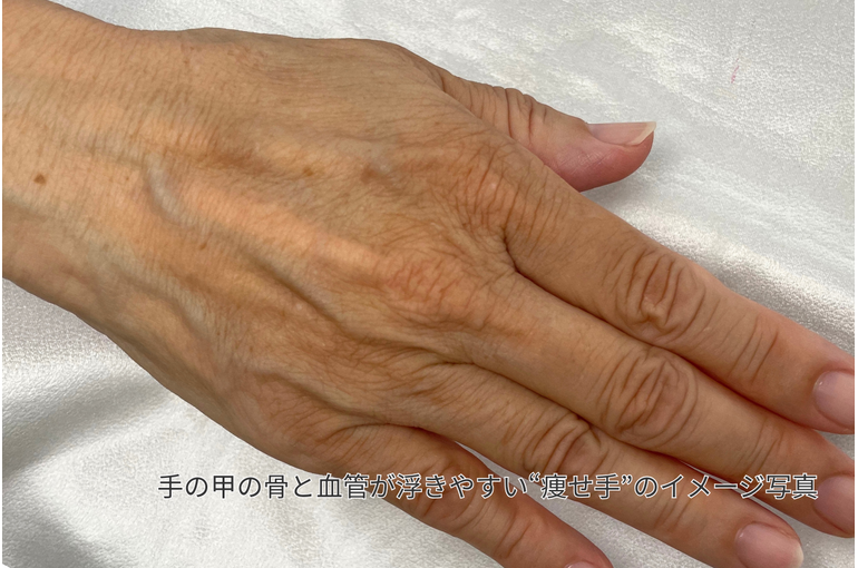 血管や骨が浮き出た手の甲の写真｜老け見え対策