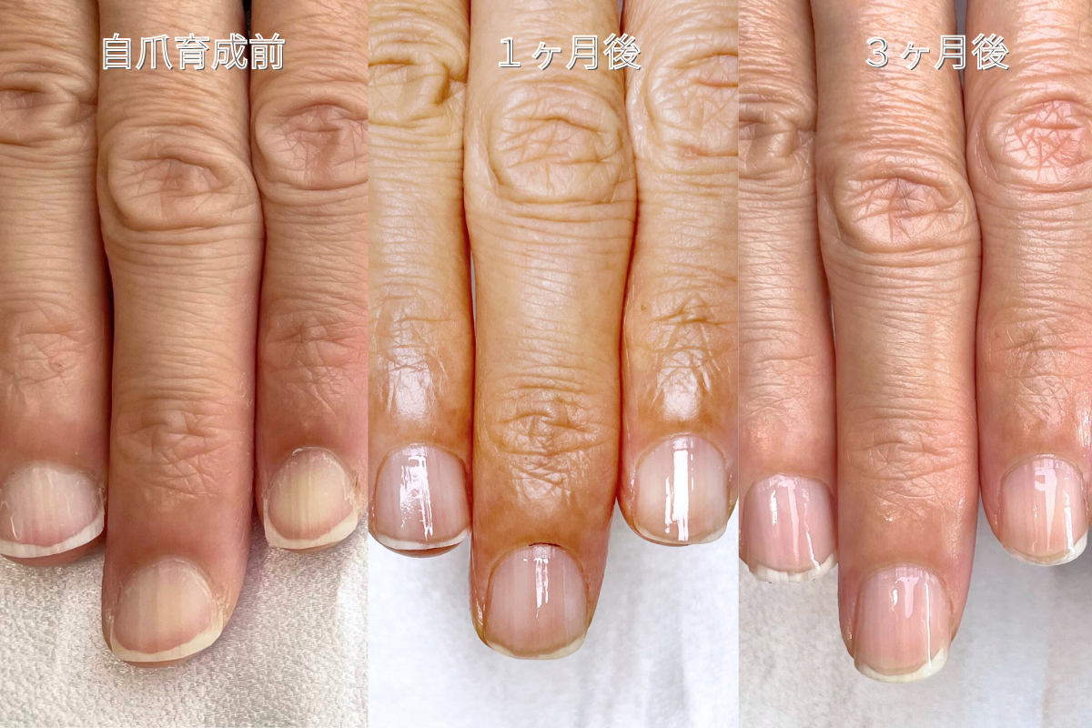 セルフ自爪育成で爪の変化を記録し経過観察する様子